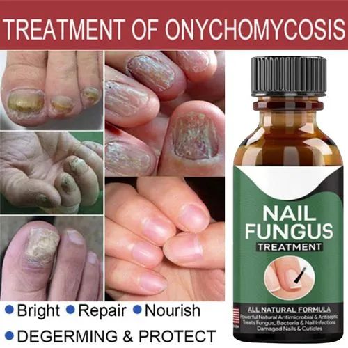 Fast Nail Fungus Treatment Gel